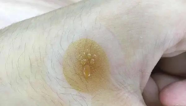 灸花，一種奇妙的花