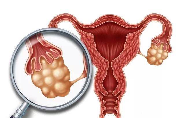 婦科“第一兇癌”！當出現這些癥狀時(shí)，婦科問(wèn)題艾灸灸什么穴位