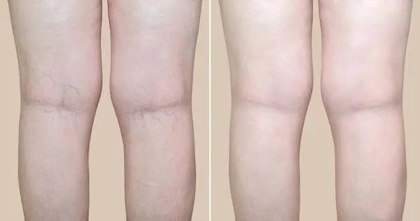 人老腳先衰，木枯根先竭，艾灸不能忘了灸腿！