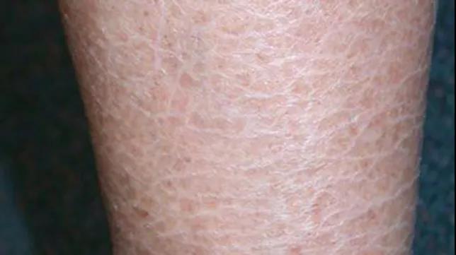 魚(yú)鱗皮膚是缺水表現嗎，問(wèn)題出在這里