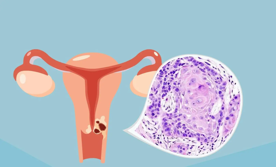 不疼不癢，竟然查出“宮頸癌”！這“3個(gè)信號”要警惕！